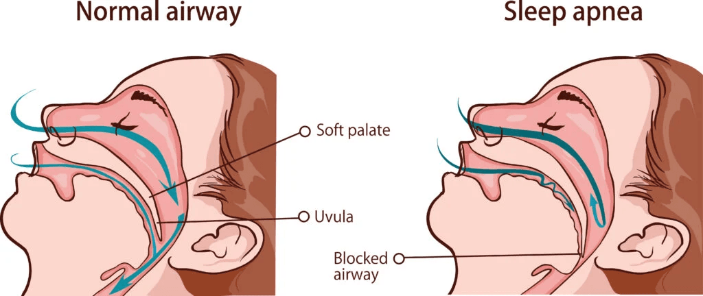 Mouth Breathing Shrinks Your Brain’s Oxygen Supply
