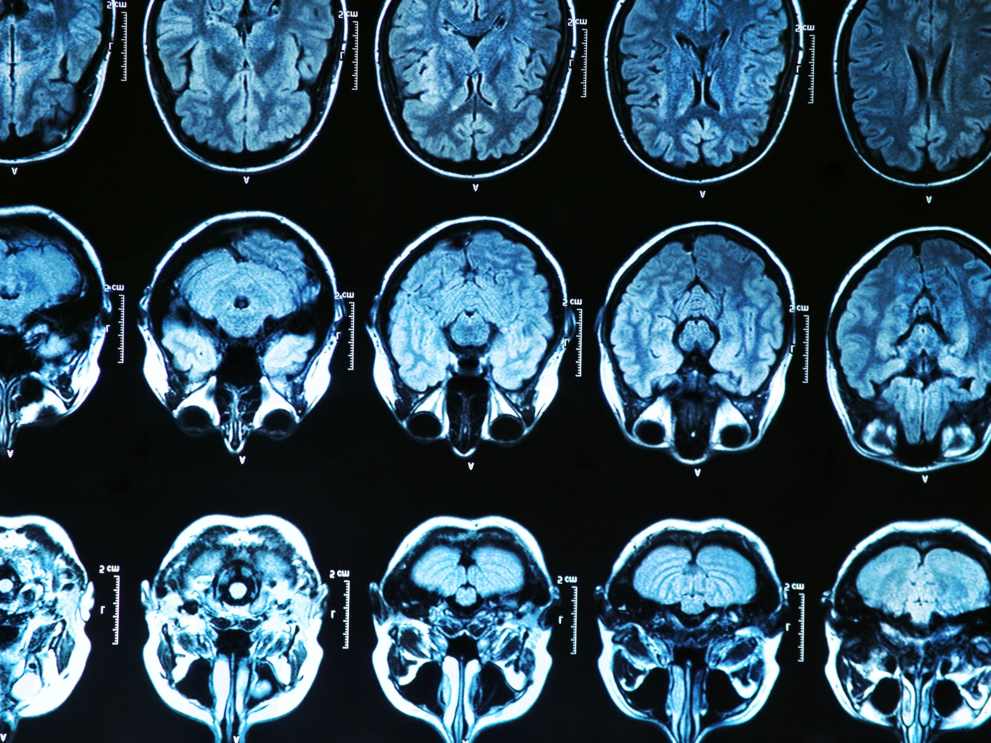 Your Brain Shrinks Without Leg Movement